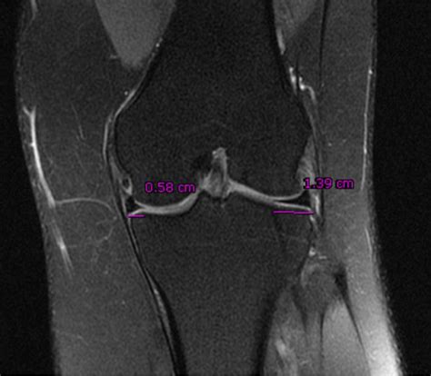 Figure From Congenital Incomplete Discoid Lateral Meniscus Of The Knee Joint A Mri Case