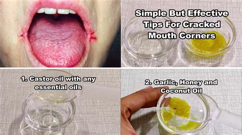 Simple But Effective Tips For Cracked Mouth Corner Angular Cheilitis Overnight Cure Remedies
