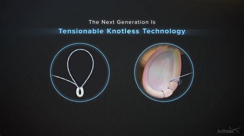 Arthrex The Next Generation Is Tensionable Knotless Technology
