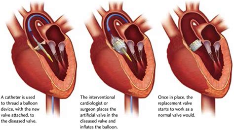 Heart Valve Replacement Surgery Need Types Procedure Benefits
