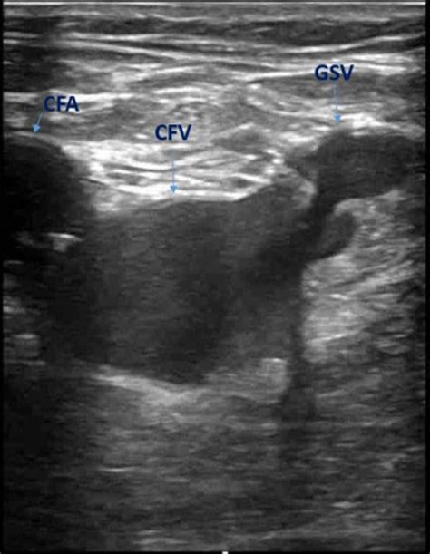 Cureus Rare Presentation Of Pulmonary Embolism Amidst Coronavirus