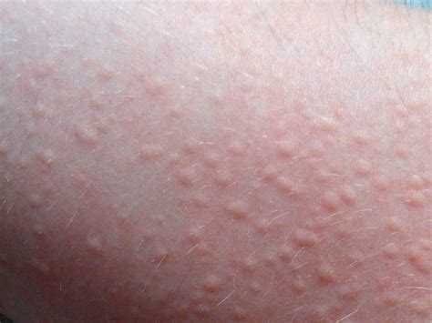 Hives Mild What Do Hives Look And Feel Like Hives Urticaria Also
