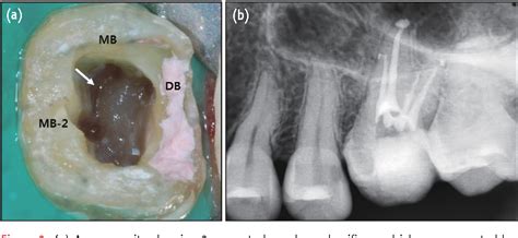 Pdf Endodontic Management Of A C Shaped Maxillary First Molar With