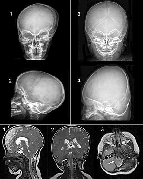 Occipital Plagiocephaly Unilateral Lambdoid Synostosis Versus