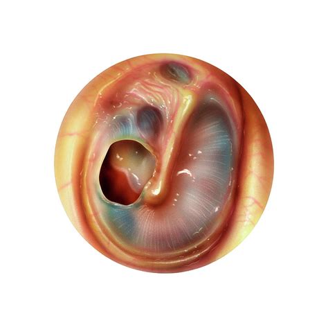 Perforated Eardrum Photograph By Bo Veislandscience Photo Library