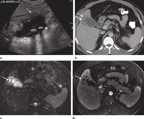 Xgc In A 63 Year Old Woman With Right Upper Quadrant Pain And Abnormal