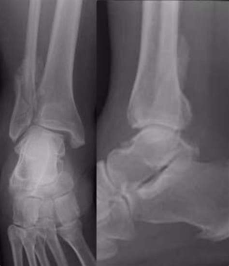 Treatment Of Distal Fibular Malunion With Corrective Osteotomy Yablon