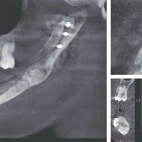 Patient 7 X Ray Of Bone Graft And 4 Dental Implants The Image Does