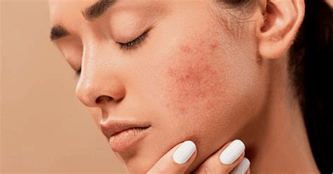 4 Common Skin Problems And How To Treat Them Mahoney Dermatology
