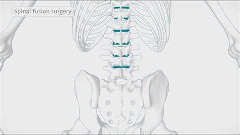 How Back Surgery Spinal Fusion Is Performed Spire Healthcare Youtube