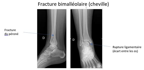Fracture Bimalléolaire Cheville Chirurgie Orthopédique Et