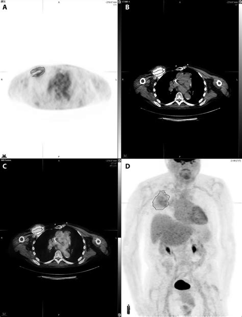 Axial Pet A Axial Ct B Axial Fused Pet Ct C And Fused D