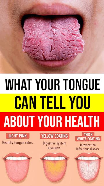 What Your Tongue Can Tell You About Your Health Rmedicaldaily