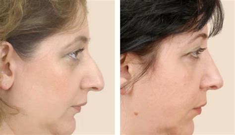 Rhinoplasty Nose Job Surgery Recovery Before And After