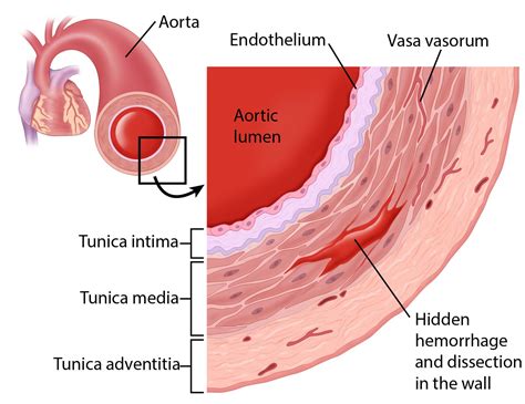 Aortic Dissection Illustration By Fran Milner Medical Illustration