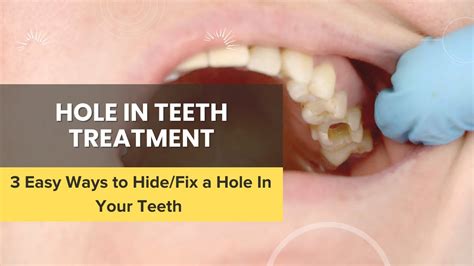Hole In Teeth Treatment 3 Easy Ways To Hide Or Fix A Hole In Your Teeth Youtube