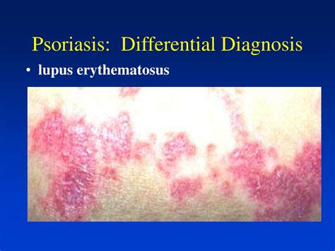 Ppt Overview Of Psoriasis Powerpoint Presentation Free Download Id