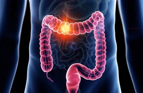 Colorectal Cancer Risk Factors Symptoms And Treatment