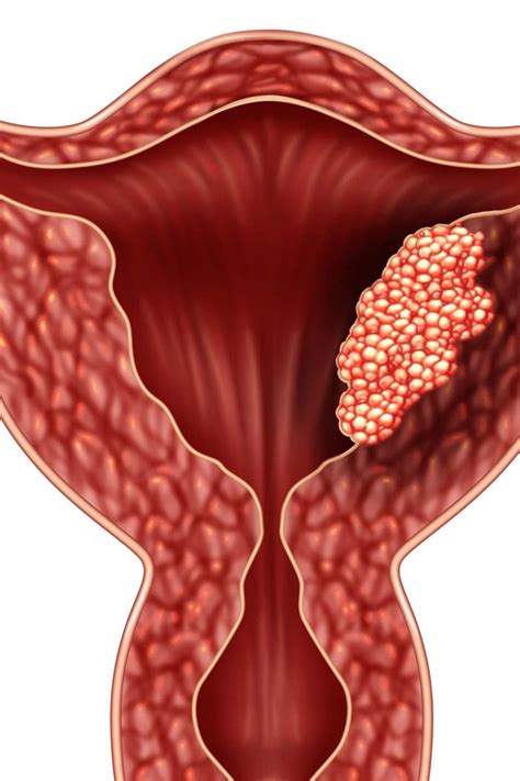 Endometrial Cancer Symptoms Staging Treatment And Causes