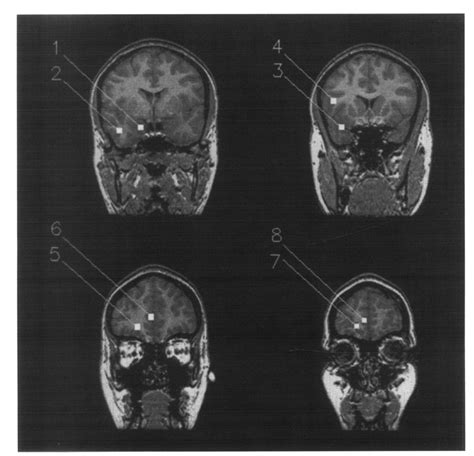 Four Coronal Slices From An Mri Of The Head Showing The 8 Dipole