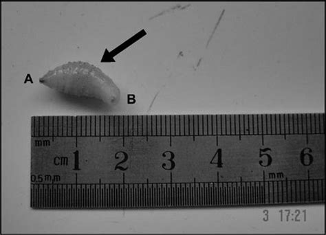 Third Stage D Hominis Larva Removed From The Lesion Note The Pyriform