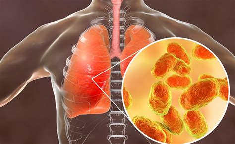 Worse Outcomes From Legionella Pneumonia In Individuals With Advanced