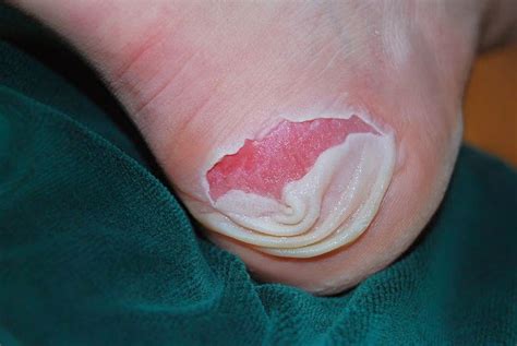 The Foot And Ankle Tribune Blister Protocols