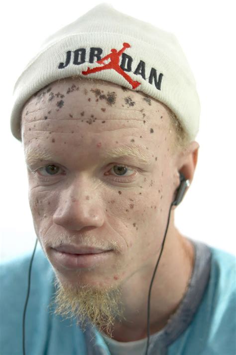 What To Know About The Albino People And Albino Disease 824news