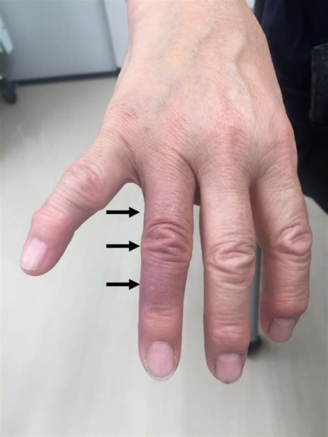 Spontaneous Discoloration Of The Finger In A 67 Year Old Woman