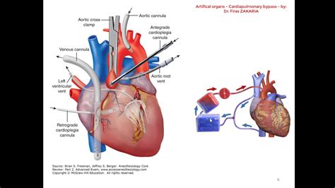 Cardiopulmonary Bypass Lecture Part I Youtube