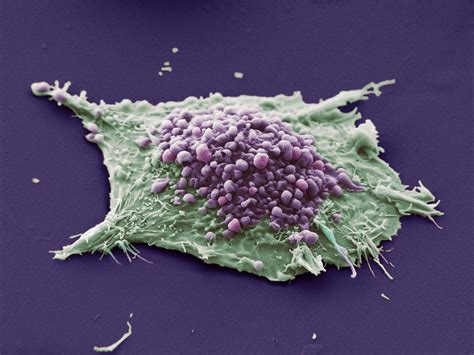 Lung Cancer Cell This Image Shows A Single Cell Grown From A Culture