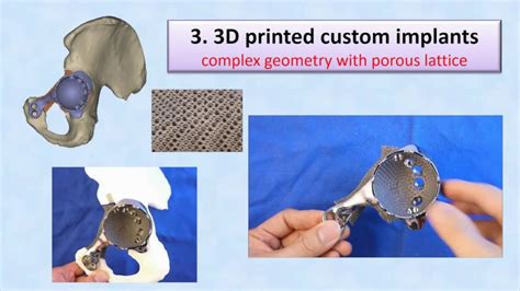 3d Printing For Patient Specific Orthopedics Video Abstract Id 99614