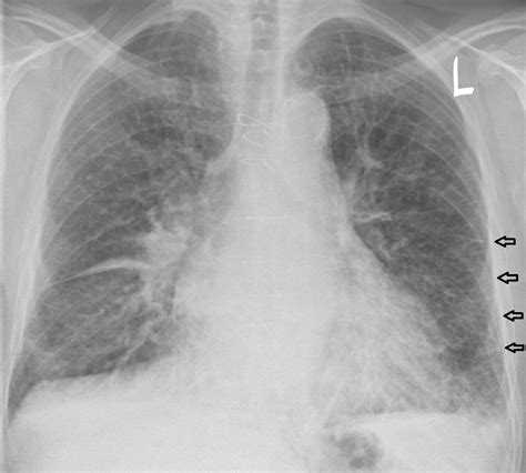 Pulmonary Edema Chest X Ray Wikidoc