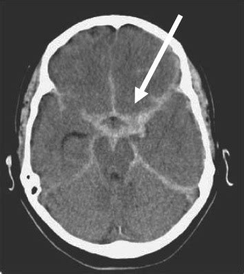 Typical Ct Scan Showing Subarachnoid Haemorrhage The Image Is Useful