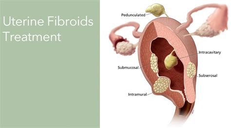 Uterine Fibroids Treatment East Norriton Womens Healthcare