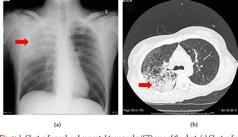 Pneumonia Ct Scan Of Chest Pneumonia 2020