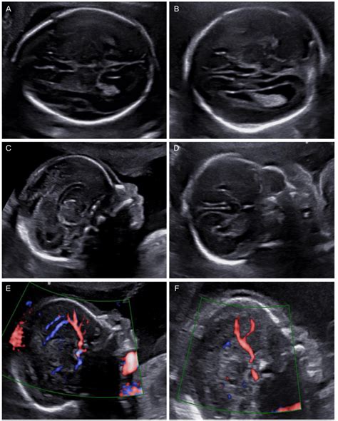 Ultrasonographic Findings In A Normal Fetus Left And With Agenesis Of