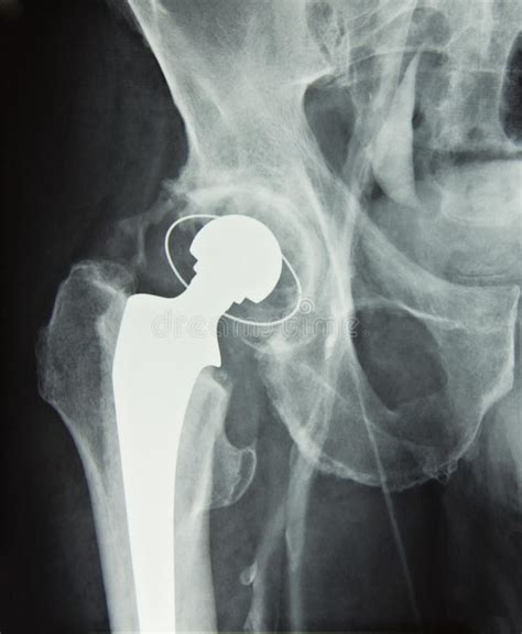 Hip Prosthesis Implant Hip Replacement Stock Image Image Of