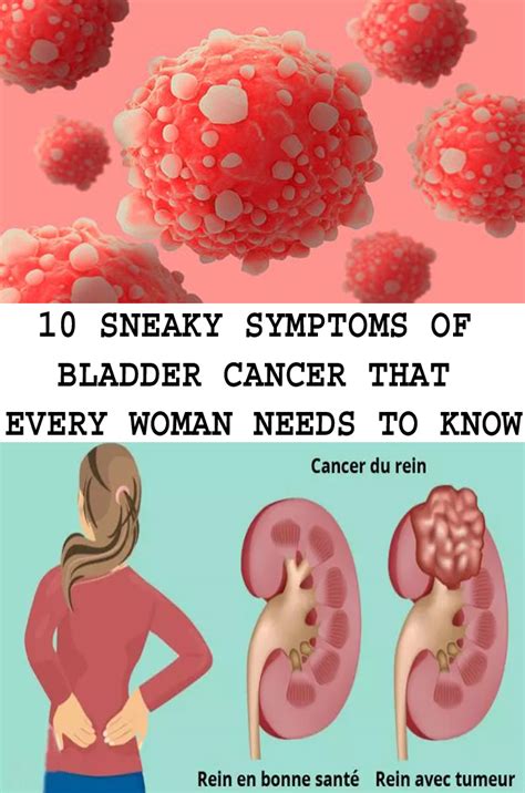 What Are The Symptoms Of Bladder Cancer In Humans Updated Guide