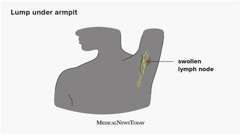 Swollen Armpit Lymph Nodes