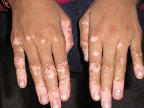 What Is Vitiligo