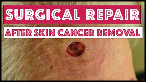 Dermatology Surgical Repair After Removal Of Skin Cancer On Forehead Youtube