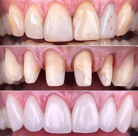 Front Anterior Teeth Emax Crowns Dental Art Dental Clinic Emax Crowns Tooth Crown Tooth