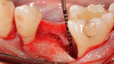Dental Clinic In Greeceathens Periodontologytissue Regeneration