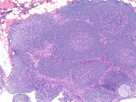 Mantle Cell Lymphoma With Mantle Zone Pattern 1
