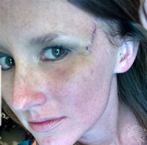 This Mother Of Two Was Left With A Hole In The Side Of Her Head After