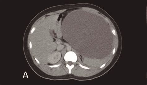 True Giants Splenic Cysts Report Of Two Cases With Laparoscopic Approach