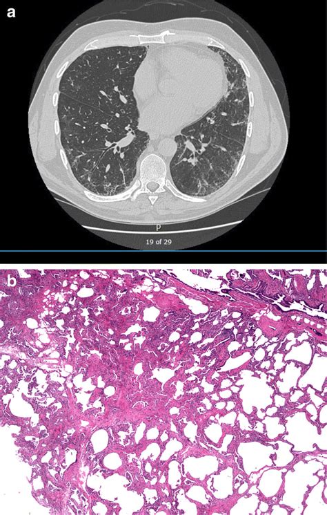 A High Resolution Chest Tomography Of Patient With Fibrotic Nonspecific