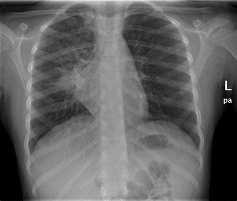 Notes On Paediatric Chest Radiography Wikiradiography