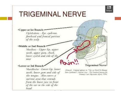Trigeminal Neuralgia Injection